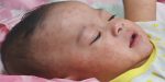 Measles patient 700 | Asean News Today
