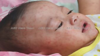 Measles cuts a deadly path through Asean