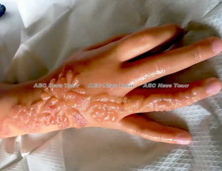 lack henna tattoos contain chemical substance that can cause severe allergic reactions, blisters, open sores, and scarring
